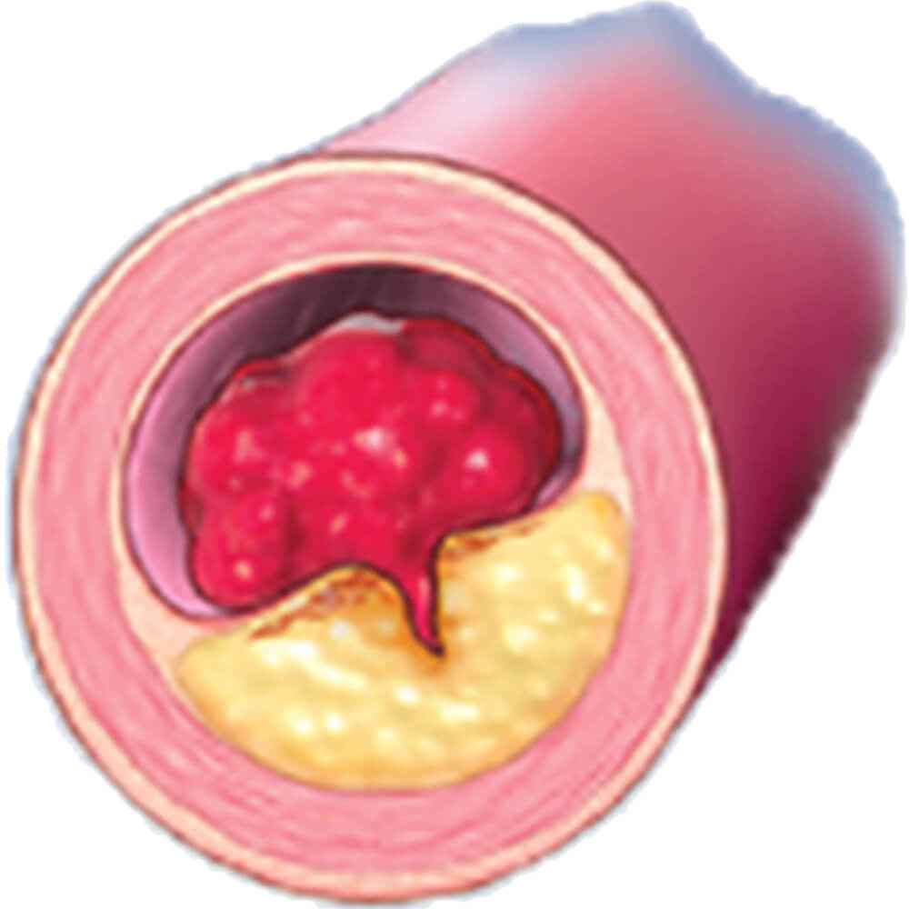 Thrombosis shown in a blood vessel