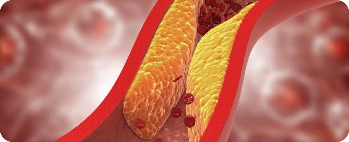 Artery walls with LDL-C build up